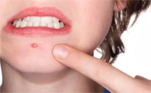 　脸颊腮帮子长痘的"幕后黑手"：你的身体正在发出这些警报！