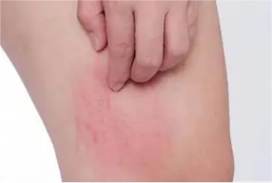 湿疹的原因和症状