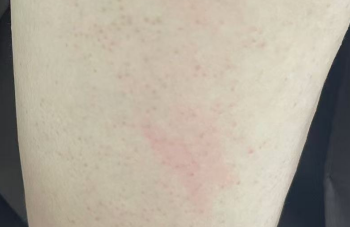 全身突然长满过敏小红点？背后原因竟藏在这些日常细节里！