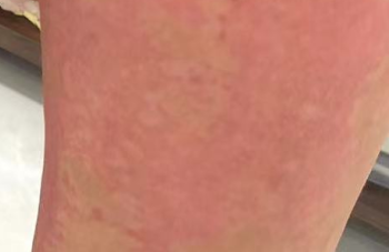 腰部过敏瘙痒难耐？别慌！这些自救方法让你轻松应对