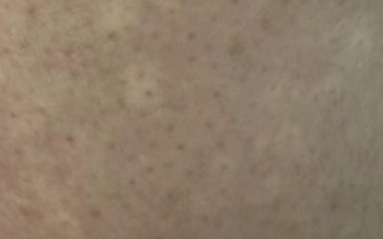 汗斑是什么原因引起的？有哪些症状？