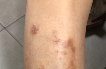 浑身瘙痒别慌张！这些“信号”要读懂，关键时刻能救命！