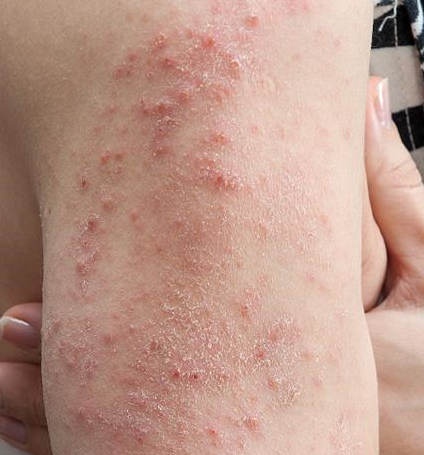 详解湿疹发作的常见原因与诱因！