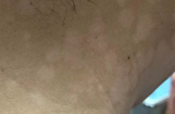 认清汗斑：别把皮肤色斑当成普通晒斑