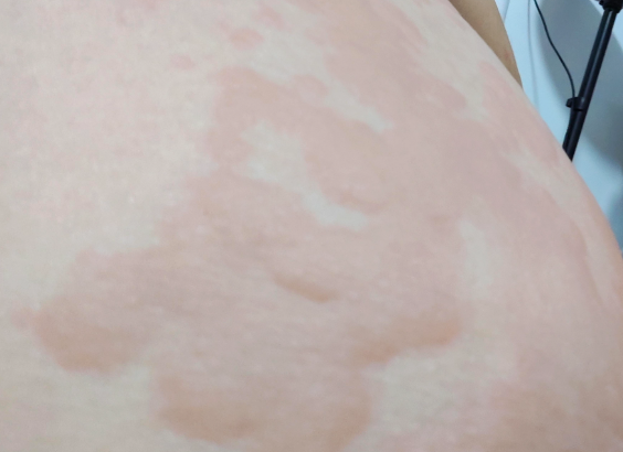 忽起忽消的风团：一文读懂常见皮肤不适