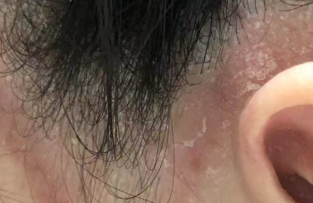 牛皮癣会传染？别让误解伤了人心！