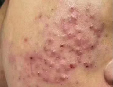 痘痘肌必看！这份“战痘”指南让你重获光滑肌