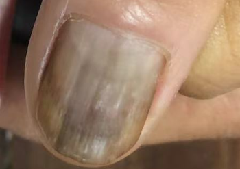 灰指甲初期信号，这些异常别忽视！