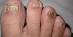珠海哪家灰指甲医院看的好