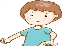 得了毛囊炎需要注意什么