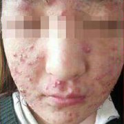 出现青春痘的主要原因有什么