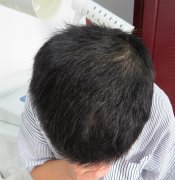 珠海好的脱发医院