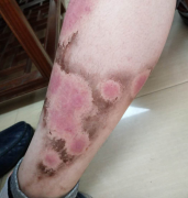 珠海哪个牛皮癣医院好