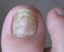灰指甲在生活中应该注意什么