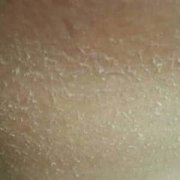 珠海导致鱼鳞病的因素有哪些