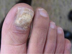 珠海治疗灰指甲哪里好的