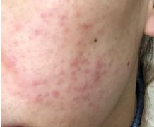 珠海斗门区治痘痘好的医院