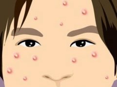 哪些习惯会导致长青春痘