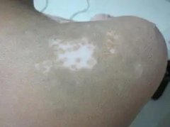 肩部白癜风要怎么治疗好