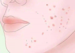 扁平疣的发病原因