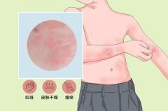 怎么治疗接触性皮炎好