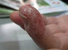 出现皮炎该怎么办