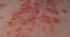 过敏性湿疹有哪些症状出现