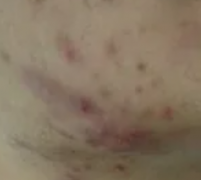 暗疮性痤疮的病因有哪些