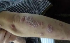关于银屑病的一些小常识