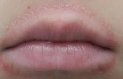 口周皮炎患者需要注意什么