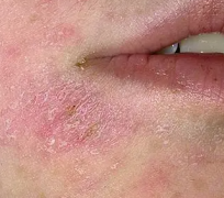 哪些食物适合口周湿疹患者吃