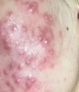 怎么正确对付激素性皮炎