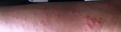 珠海丘疹性荨麻疹怎么治疗