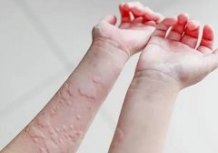 珠海急性荨麻疹是怎么引起的