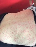 珠海荨麻疹消了又起是什么原因