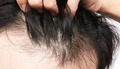 珠海青少年脱发是什么原因呢