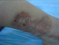 珠海腿上有疤痕怎么去除