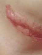 珠海老烫伤增生疤痕怎么办