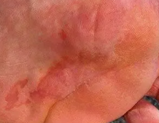 珠海脚底湿疹怎么治疗