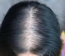 珠海怎么治疗脱发女生