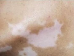 珠海脸上出现白斑是什么原因
