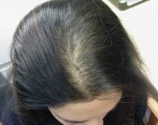 珠海女性脱发的原因有哪些