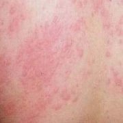 珠海大腿湿疹是怎么引起的