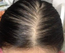 珠海脂溢性脱发怎么恢复发量