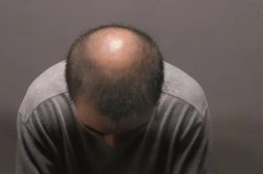 男生脱发怎么养回来
