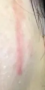 皮肤过敏留下的疤痕怎么去除