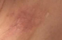 脖子上湿疹是什么原因
