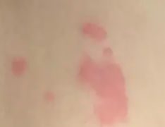 丘疹性荨麻疹是什么引起的
