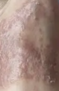 脚湿疹特别痒应该怎样治疗