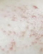 手臂起了湿疹怎么办